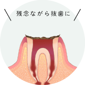 残念ながら抜歯に