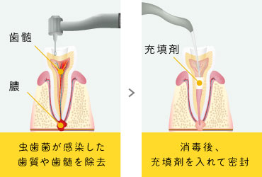 虫歯菌が感染した歯質や歯髄を除去 消毒後、充填剤を入れて密封