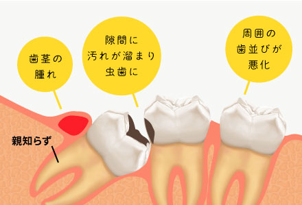 隙間に汚れが溜まり虫歯に 周囲の歯並びが悪化 歯茎の腫れ